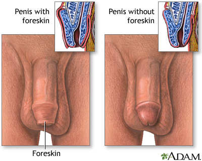 Penis - with and without foreskin