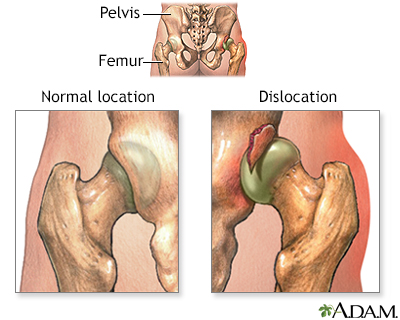 Dislocation of the hip - Illustration Thumbnail
              