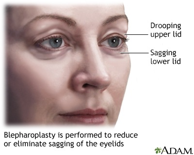 Blepharoplasty - series - Presentation Thumbnail
                    