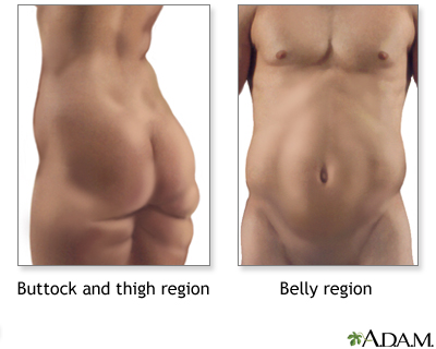 How to Prevent and Correct Uneven Areas in Your Belly After Liposuction