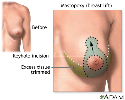 Breast lift (mastopexy) - series - Incisions