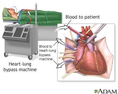 Heart-lung bypass machine