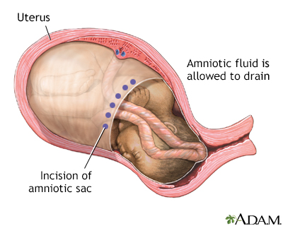 Falta de líquido amniótico en el embarazo consecuencias