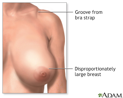 Breast augmentation surgery Information