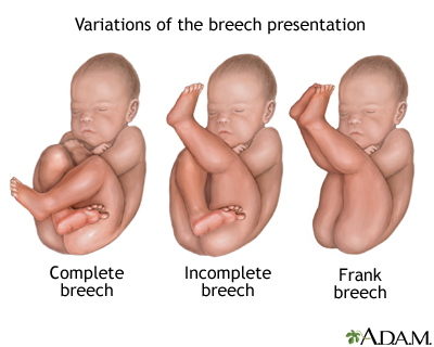 Types of breech presentation