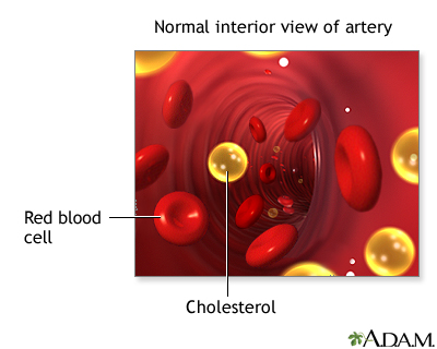 Why Is Your Cholesterol Still High? 12 Common Reasons