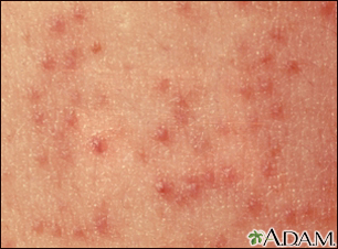 Atopic dermatitis | Mount Sinai - New York