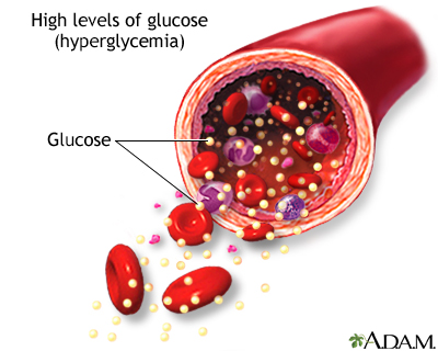High blood sugar - Illustration Thumbnail
                      