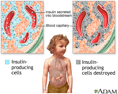 Type I diabetes - Illustration Thumbnail
              