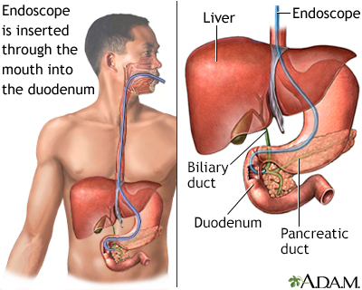 ERCP: What It Is, Why It's Done, Procedure & Complications