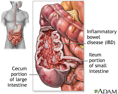 Crohn's Disease: What It Is, Symptoms, Causes & Treatment