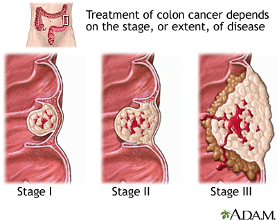 cancer colon bleeding