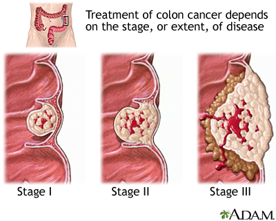 stages of colon polyps