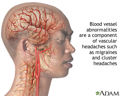 Vascular headaches