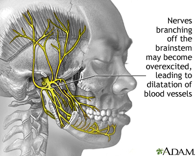 Migraine Information Mount Sinai New York