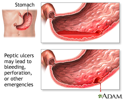 Urgences ulcéreuses