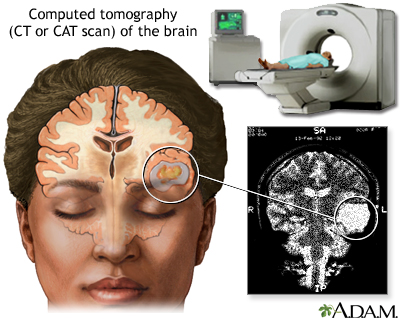 CT scan of the brain - Illustration Thumbnail
              