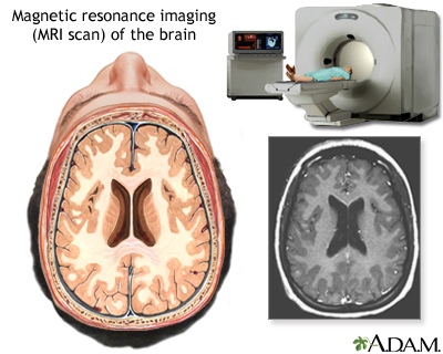 metastatic brain cancer symptoms