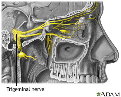 cluster headaches diagram