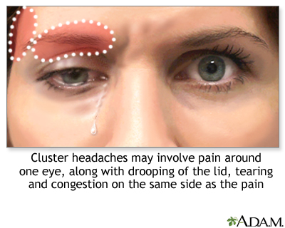 Pain of cluster headache - Illustration Thumbnail
              