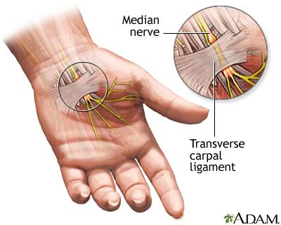 Compression of the median nerve - Illustration Thumbnail
              