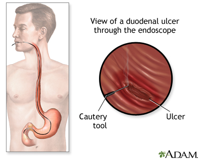 Gastroscopy procedure - Illustration Thumbnail