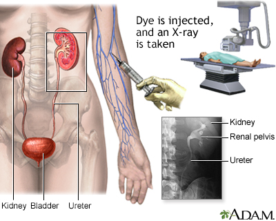 Intravenous pyelogram (IVP) - Illustration Thumbnail
                      