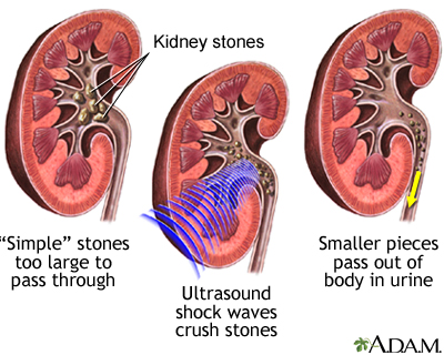 Kidney Stones Lithotripsy Discharge Information Mount Sinai New York