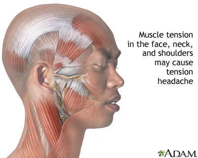 Tension-type headache - Illustration Thumbnail
                      