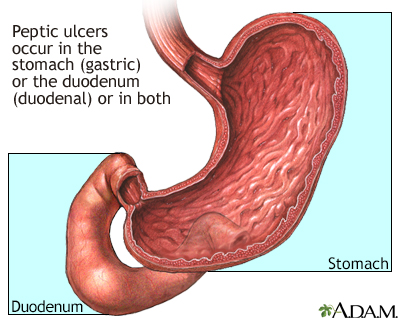 stomach ulcer pain location