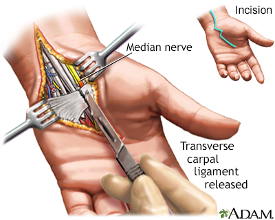 Carpal tunnel surgical procedure