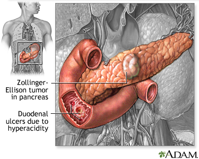 duodenal ulcer pain location