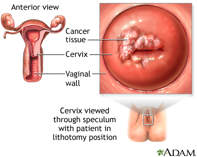 Signs of cervical cancer may include abnormal vaginal bleeding, such as  bleeding between periods, after sex, or after menopause. Addition