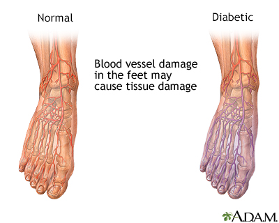 Diabetic blood circulation in foot - Illustration Thumbnail              