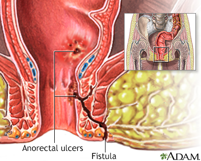 Anorectal fistulas - Illustration Thumbnail
              