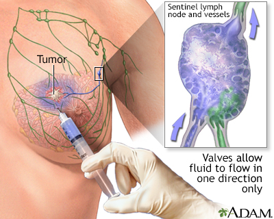 TMR International Hospital - Do Lumps Always Mean Breast Cancer