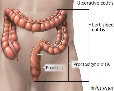 Ulcerative colitis - Illustration Thumbnail