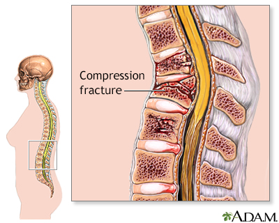 Compression spinal fracture