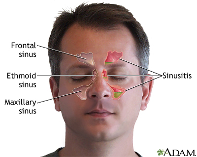 Sinus Infection (Sinusitis) - Symptoms and Causes