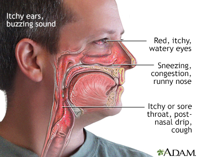 Allergy symptoms - Illustration Thumbnail
                      