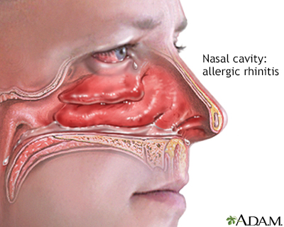 Why Does Pollen Cause Allergies?  New York Allergy and Sinus Centers