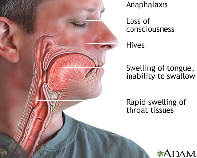 Anaphylaxis - Illustration Thumbnail
                      