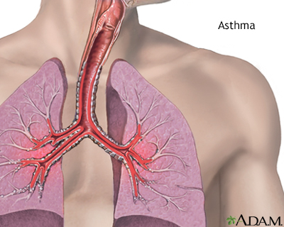 Asthma Information  Mount Sinai - New York