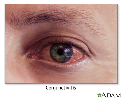 Allergic conjunctivitis Information | Sinai - New