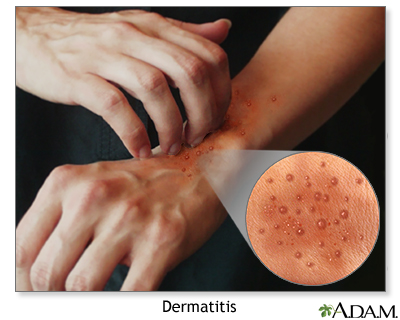 dyshidrotic eczema dyshidrotic dermatitis