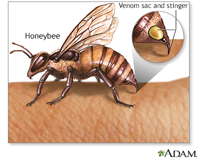 Insect stings and allergy - Illustration Thumbnail
              