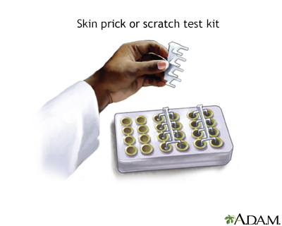 Allergy skin prick or scratch test - Illustration Thumbnail