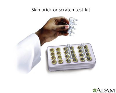 Allergy skin prick or scratch test - Illustration Thumbnail
                      