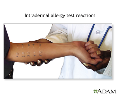 Intradermal allergy test reactions - Illustration Thumbnail
                      