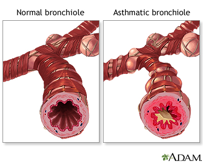 Bronchiole normale versus asthmatique